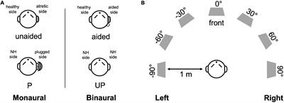 Characteristics of sound localization in children with unilateral microtia and atresia and predictors of localization improvement when using a bone conduction device